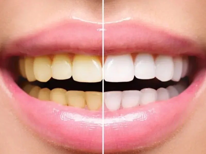 Clareamento Dental