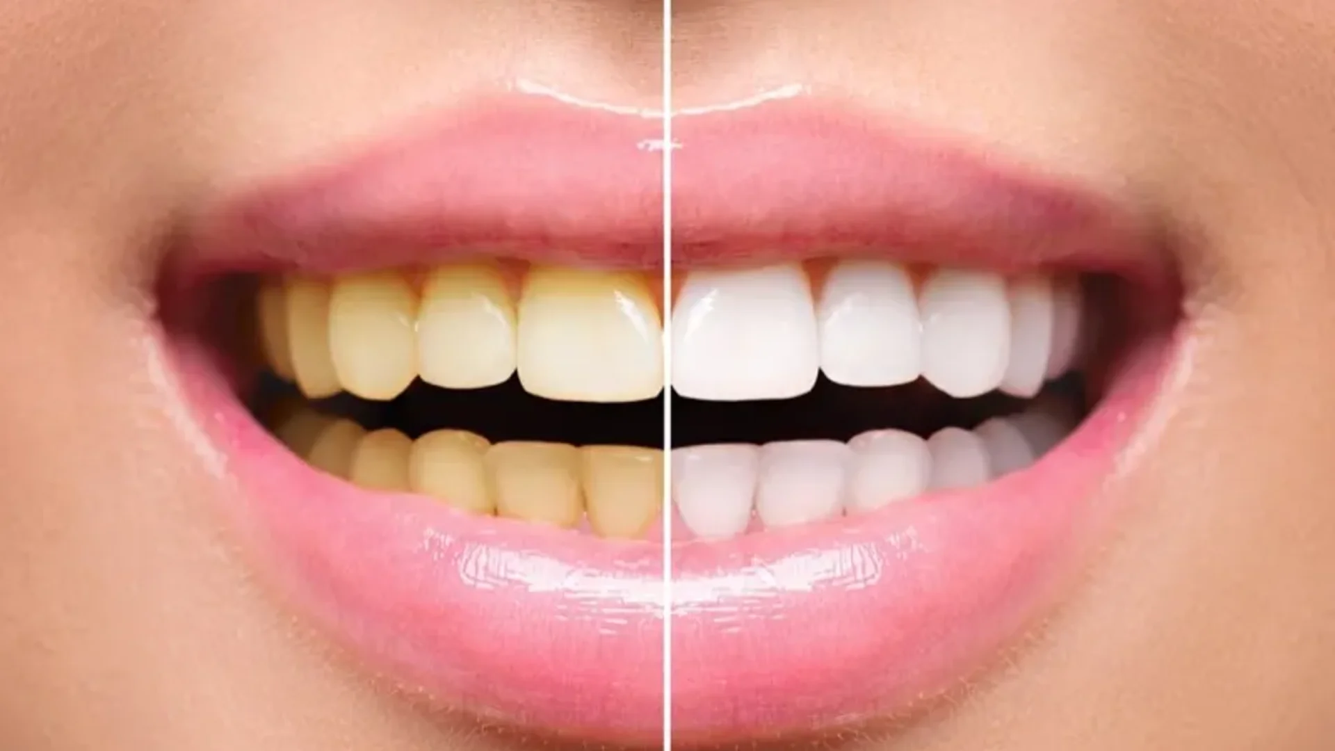 Clareamento — Sorriso Mais Branco