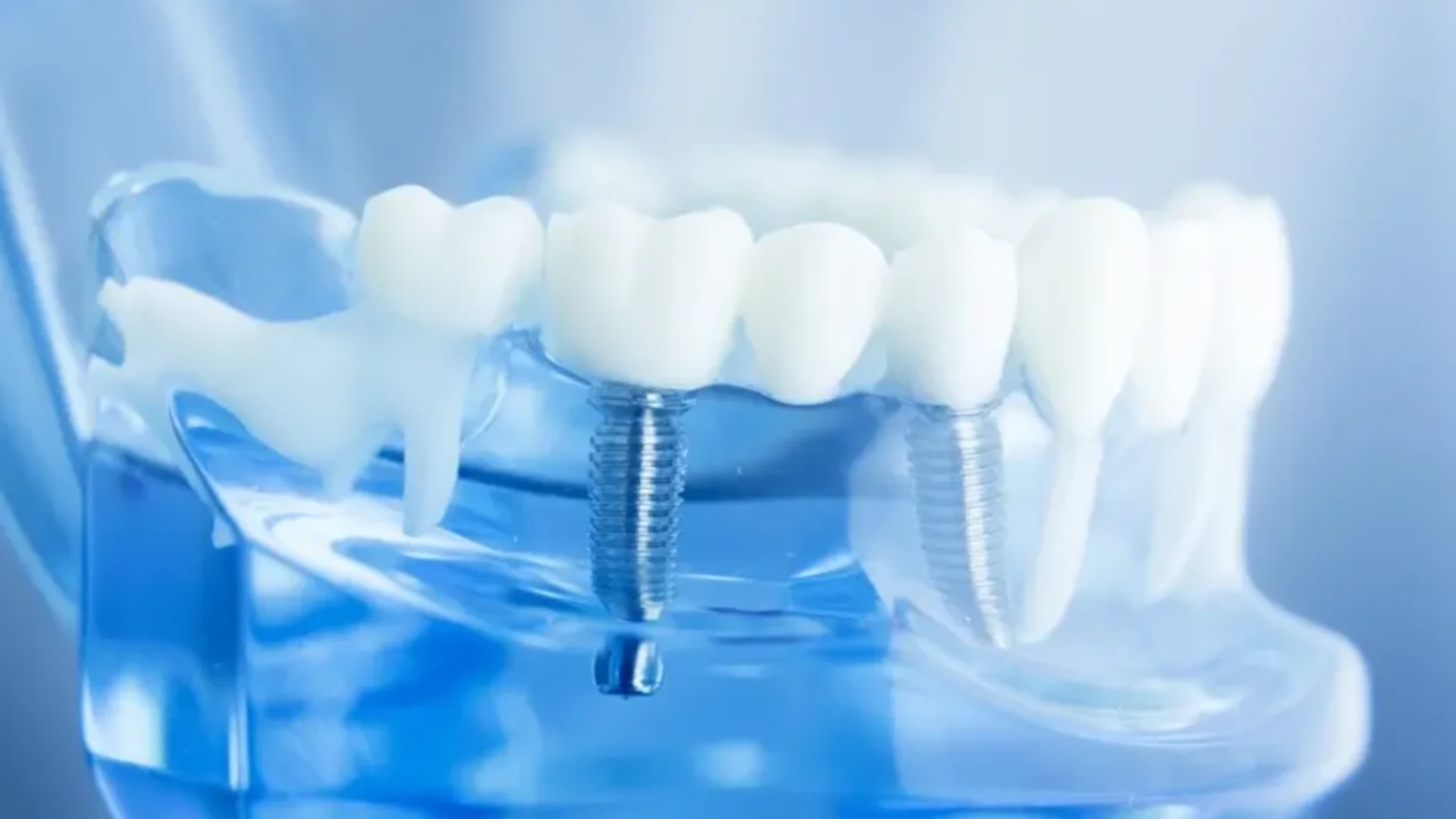 Implantodontia — Dentes para Toda a Vida