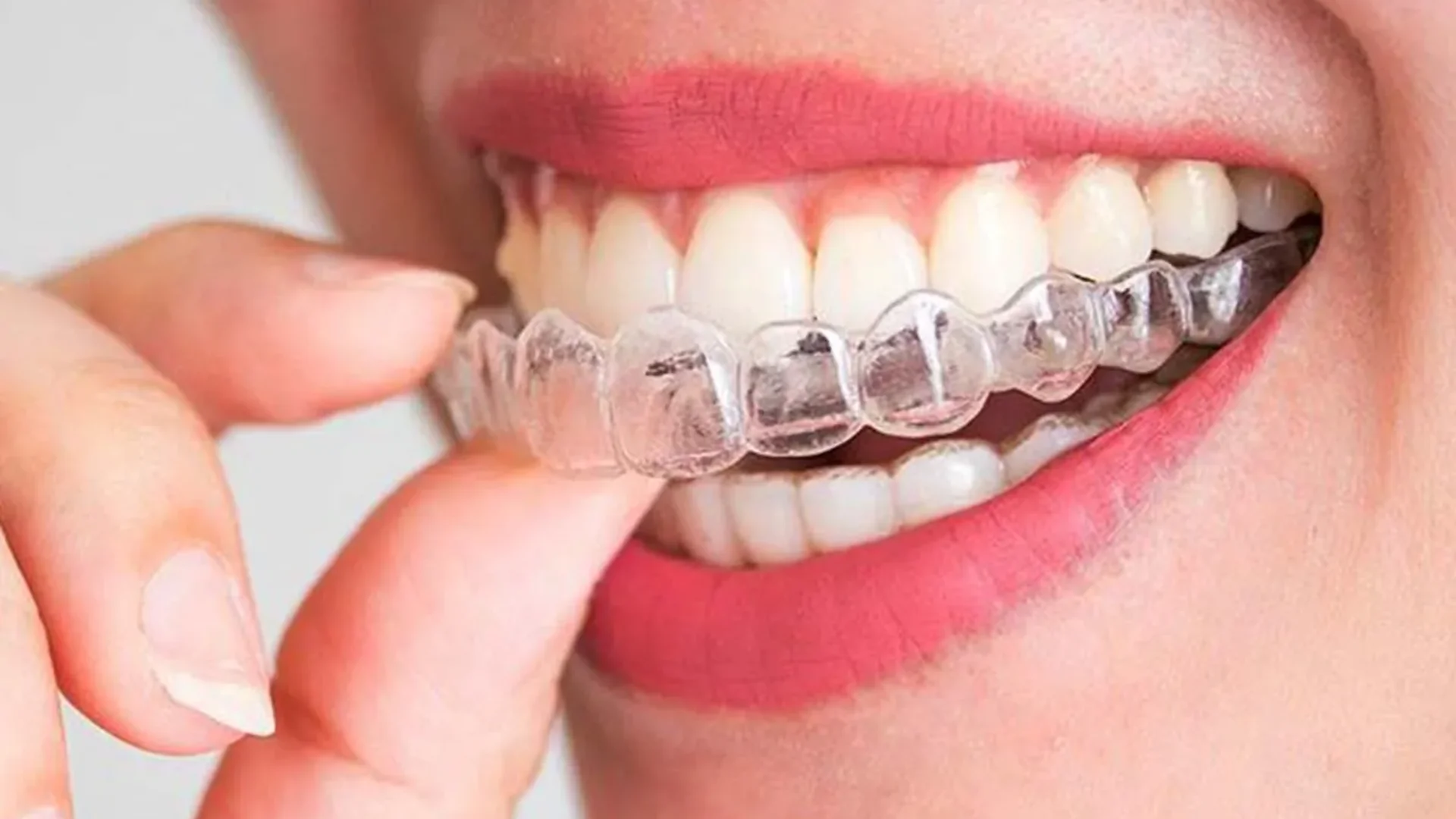 Invisalign — Alinhadores Invisíveis