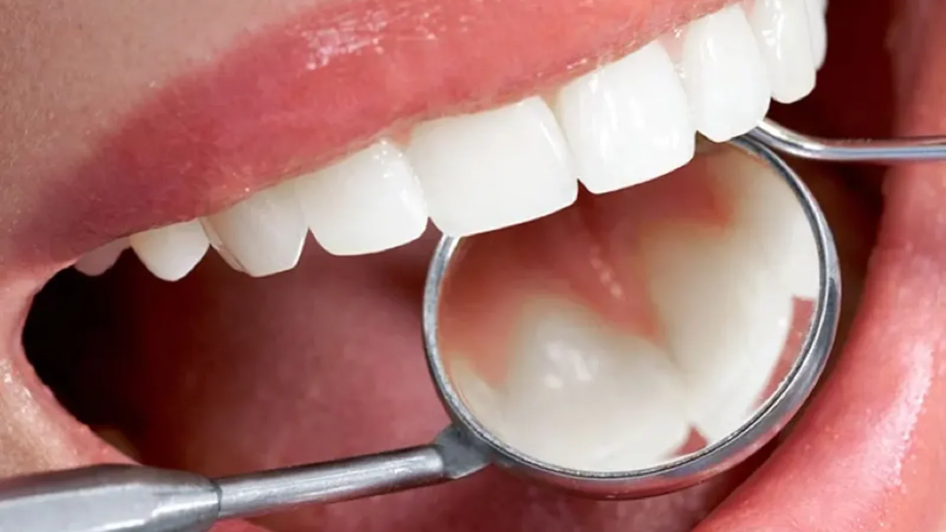 Periodontia — Saúde da Gengiva